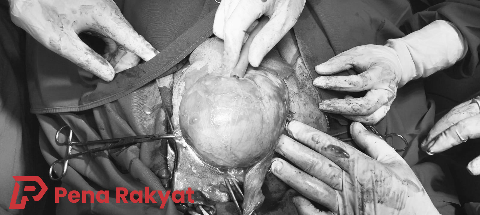 Menjaga Kesehatan Reproduksi: Sukses Operasi Tumor Testis di RSUD Genteng